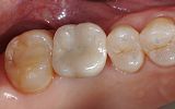 missing tooth replaced with an implant supported porcelain crown after