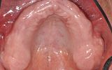 Upper jaw with no teeth