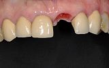 missing tooth replaced with an implant supported porcelain crown before