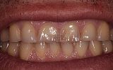 Simple white filling placement -before image - Central incisor