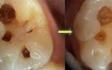 Simple white filling showing decay removal before and after