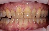 Simple white filling placements -before image - Central incisors