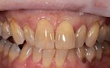 Simple white filling placements -after image - Central incisors