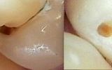 Simple white filling showing decay removal before and after