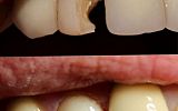 Composite Resin Filling Build Up to restore decayed broken down tooth