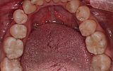 Amalgam filling replacements with White Fillings and Emax Overlays After