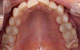 Amalgam filling replacements with White Fillings and Emax Overlays After
