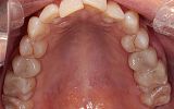 Amalgam filling replacements with White Fillings and Emax Overlays After