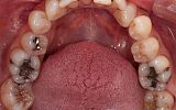 Amalgam filling replacements with White Fillings and Emax Overlays Before