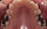 Amalgam filling replacements with White Fillings and Emax Overlays Before