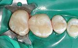 3 Amalgam Fillings about to be replaced under rubber dam after
