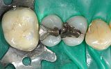 2 Amalgam Fillings about to be replaced under rubber dam before
