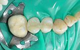 2 Amalgam Fillings replaced with composite resin under rubber dam after