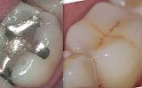 Amalgam filling removed  and tooth prepared for Emax overlay Crown under rubber dam 