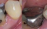 Amalgam filling removed  and tooth prepared for Emax overlay Crown under rubber dam 