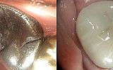 Amalgam filling removed  and tooth prepared for Emax overlay Crown under rubber dam 