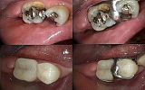 Amalgam fillings replaced with Emax crowns cloned so old denture still fits