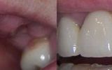 3 Tooth Valplast Denture 