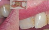 2 Tooth Valplast Denture 