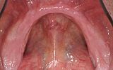 Lower  jaw with no teeth