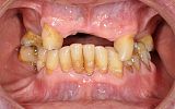 Missing upper teeth replaced with special attachment crowns and  chrome cobalt denture before