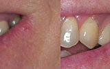 2 Tooth Valplast Denture 