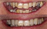 9 Emax Porcelain overlay crowns and veneers to subtly improve appearance