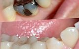 Amalgam fillings removed  and teeth prepared for Emax overlay Crowns under rubber dam 