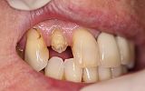 Same day Emax Porcelain crown to repair a fractured tooth Before