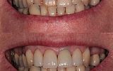 3 Emax porcelain veneers & crown