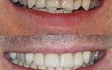 4 Emax overlay crowns