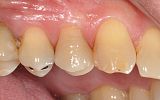 Emax porcelain crown bonded to tooth