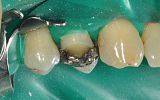 Amalgam filling and broken cusp under rubber dam