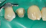 Amalgam filling removed  and tooth prepared for Emax overlay Crown under rubber dam 