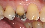 Amalgam filling and broken cusp