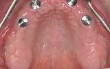 Upper jaw with no teeth and 4 dental implants