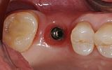 missing tooth replaced with an implant supported porcelain crown