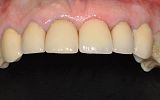 missing tooth replaced with an implant supported porcelain crown