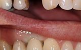 missing tooth replaced with an implant supported porcelain crown