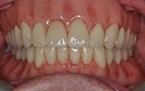 Uppe and lower implant supported all on four dentures