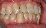 missing tooth replaced with an implant supported porcelain crown