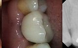 missing tooth replaced with an implant supported porcelain crown