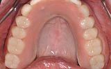 Upper implant supported all on four denture