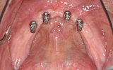 lower  jaw with no teeth and 4 dental implants