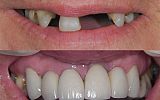 missing teeth replaced with implant crowns & implant supported Cantilever Bridge