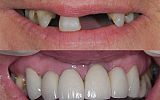 missing teeth replaced with implant crowns & implant supported Cantilever Bridge