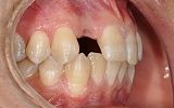 missing tooth replaced with an implant supported porcelain crown