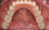 lower implant supported all on four denture