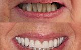 Full Upper Denture