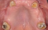 Missing upper teeth